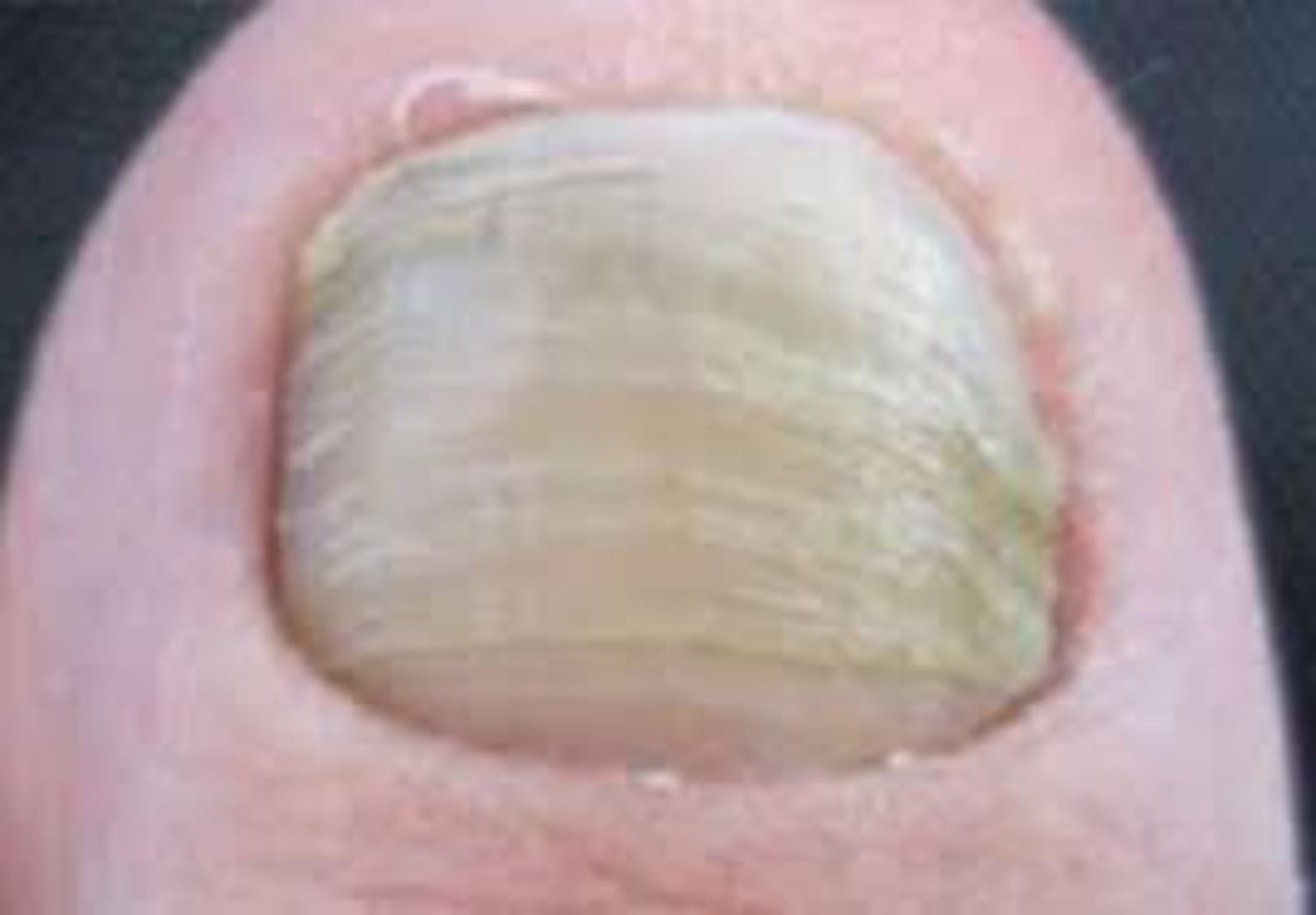 ضخیم شدن ناخن