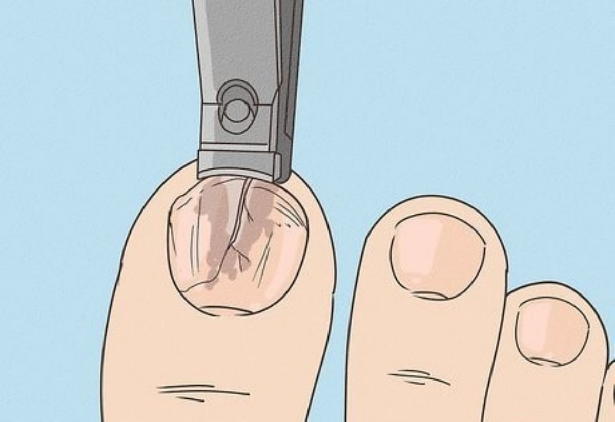 افتادن ناخن پا 