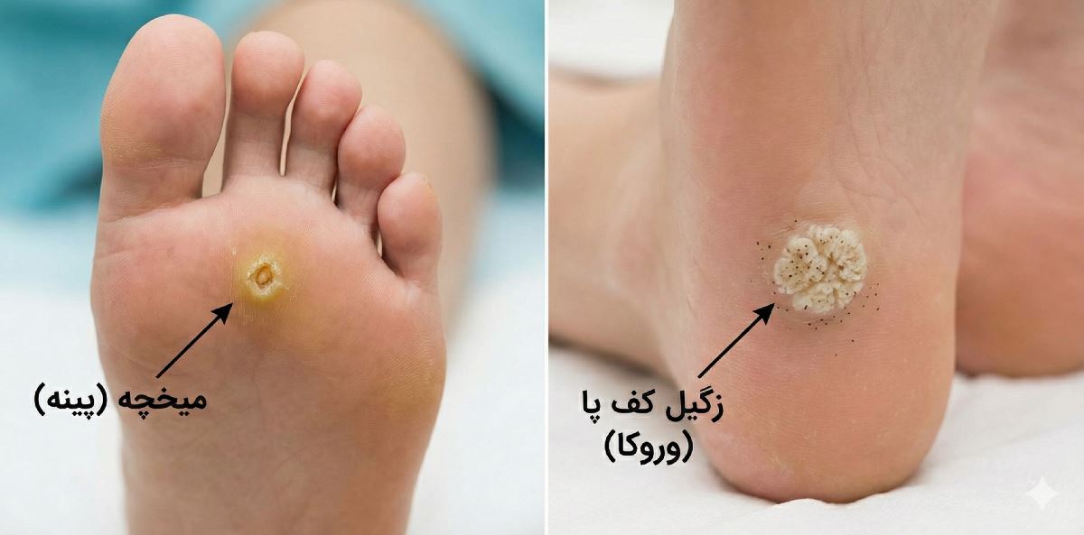 زگیل کف پا (Verruca) یا میخچه؟